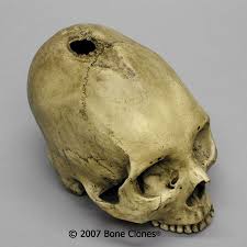 mary's possible bullet wound 21